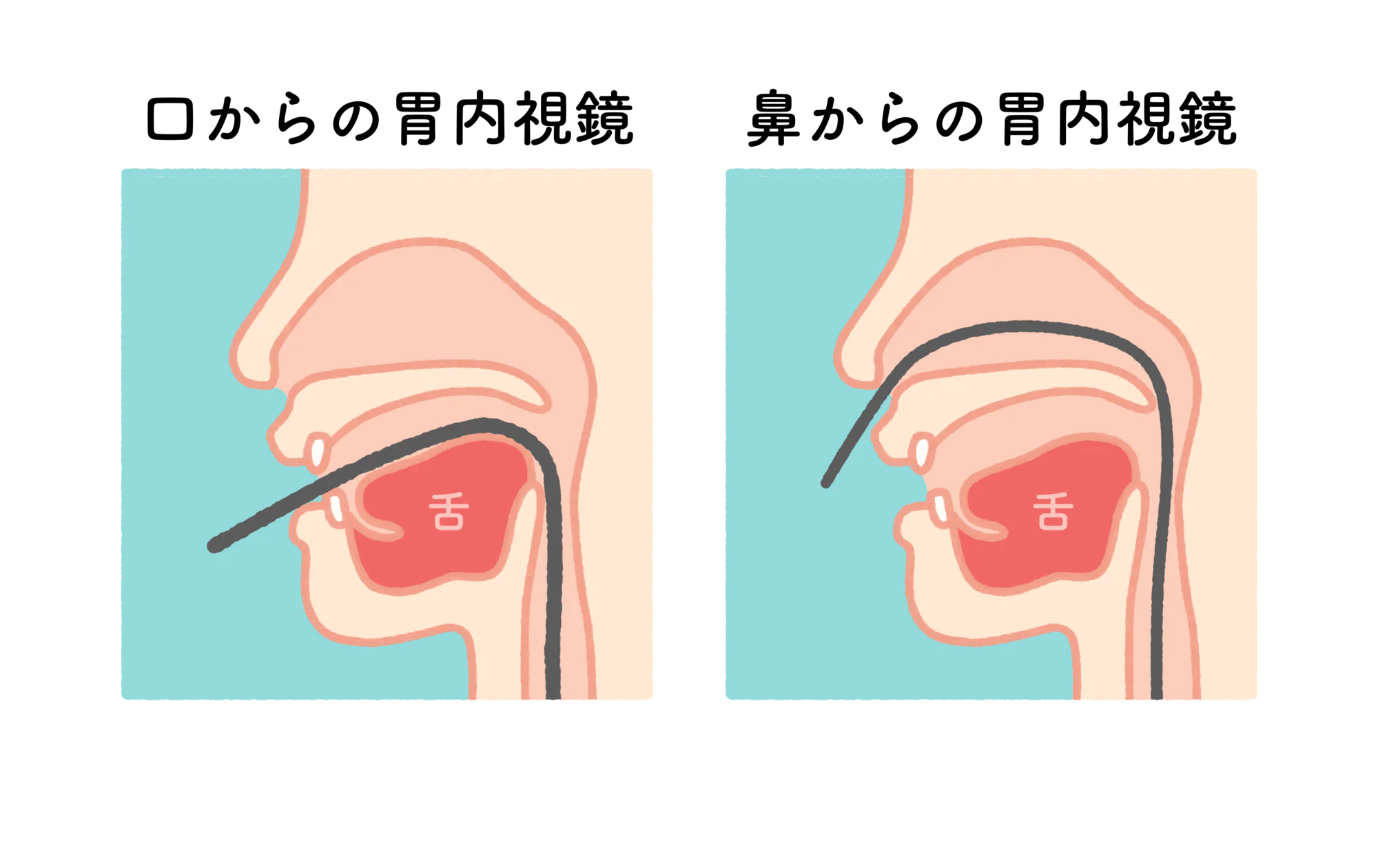 経鼻と経口検査を選べます